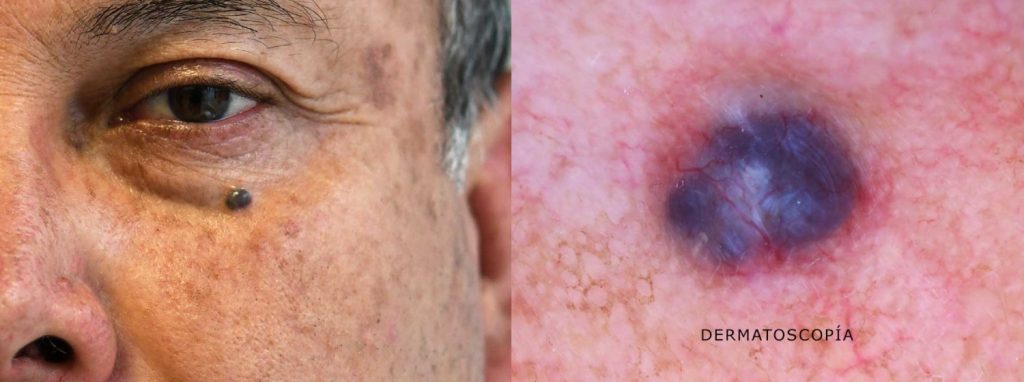 Carcinoma Basocelular - Derma AID - Dr. Víctor Hugo Pinos