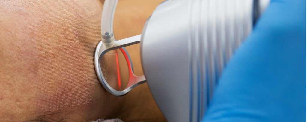 Láser para Rejuvenecimiento - Derma AID - Dr. Víctor Hugo Pinos
